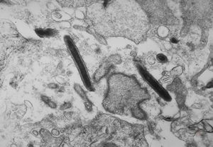 F,41y. | Whipple disease - duodenum F,41y. | Whipple disease - duodenum